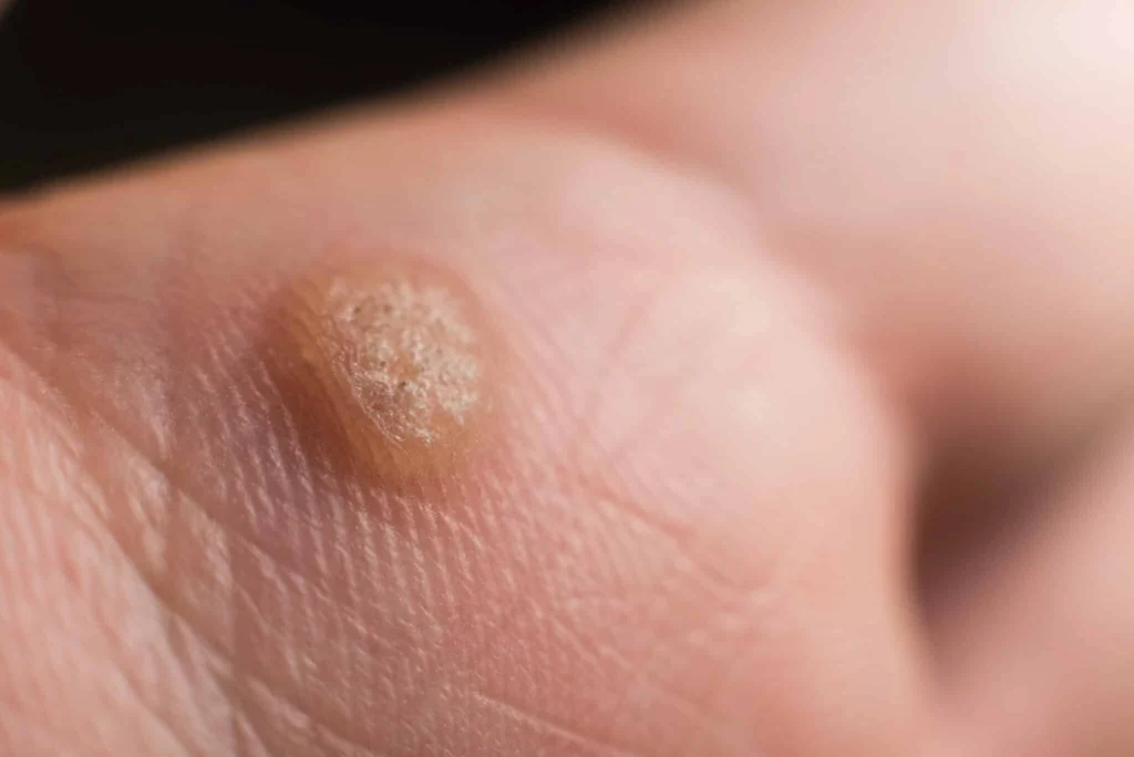 CryoPen treatment for Common Warts showing precise freezing of viral skin lesions for safe and effective removal Doncaster