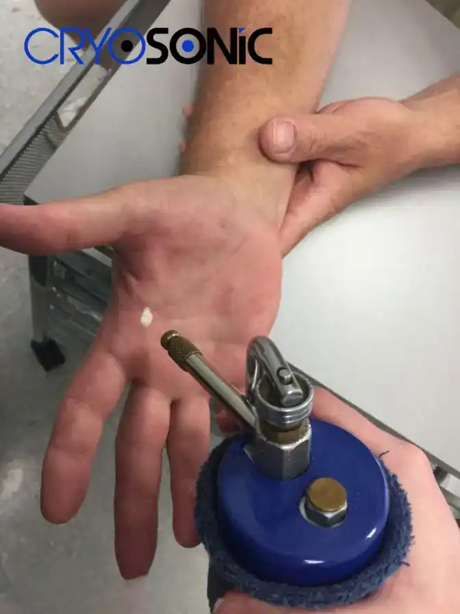 Temperature Differences: OTC vs Medical-Grade Cryotherapy Doncaster